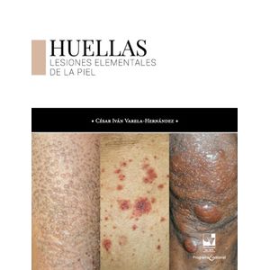 Portada del libro HUELLAS LESIONES ELEMENTALES DE LA PIEL Autor VARELA HERNNADEZ, CESAR IVAN